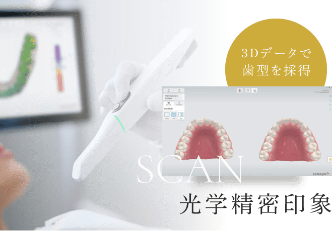 光学精密印象 3Dデータで歯型を採得