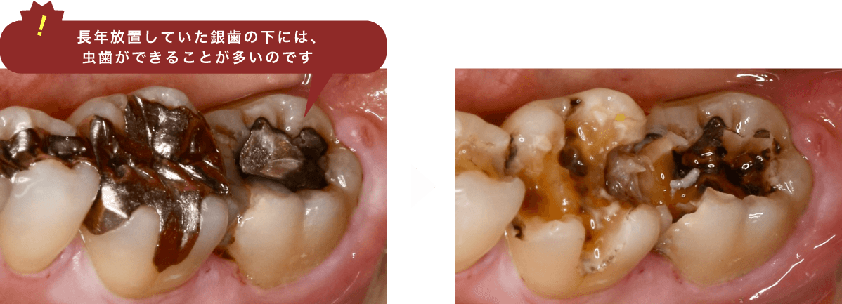 銀歯の下は虫歯かも?